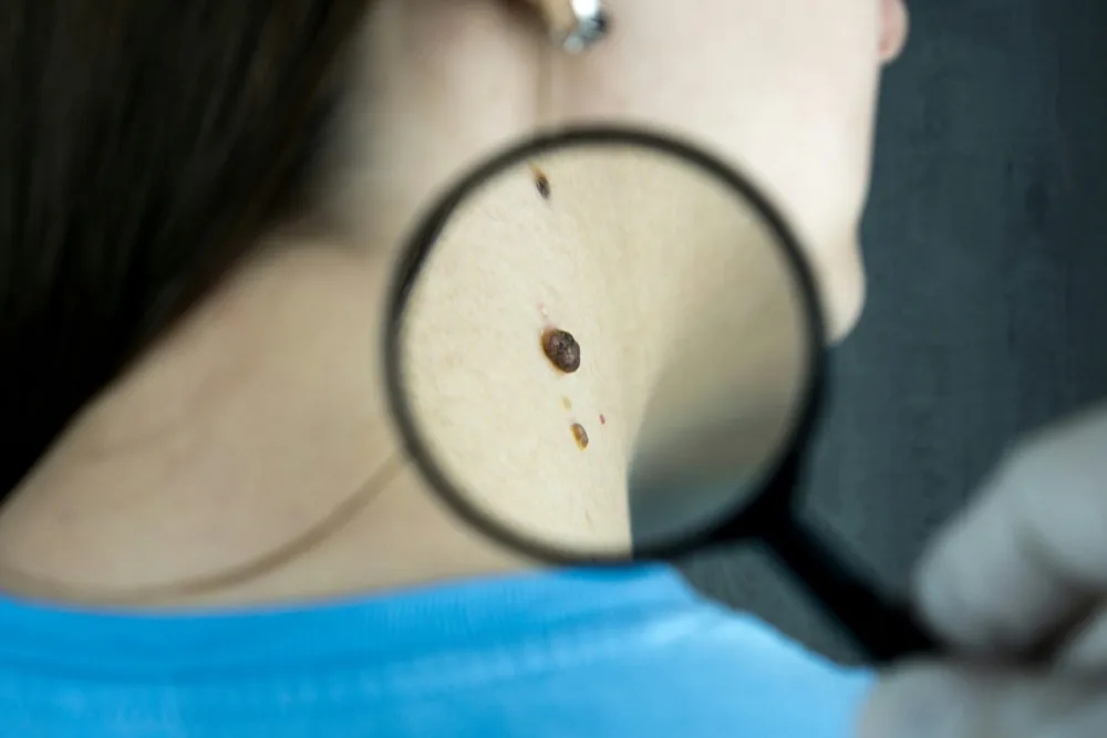 Mole scanning skin check